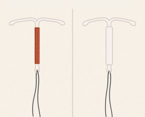 Kupferspirale vs Hormonspirale Kupferspirale und Hormonspirale